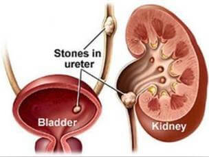 Renal colic. Symptoms, first aid and treatment.