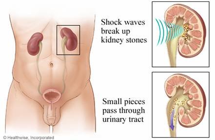Renal colic. Symptoms, first aid and treatment.