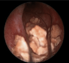 Remote shock wave lithotripsy in the era of endoscopy