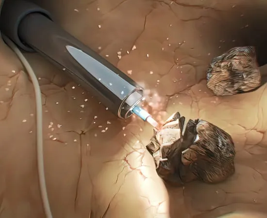 Laser Lithotripsy
